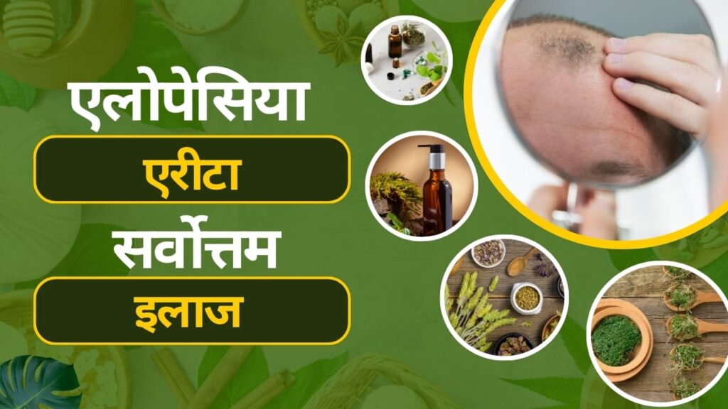 alopecia areata treatment in hindi