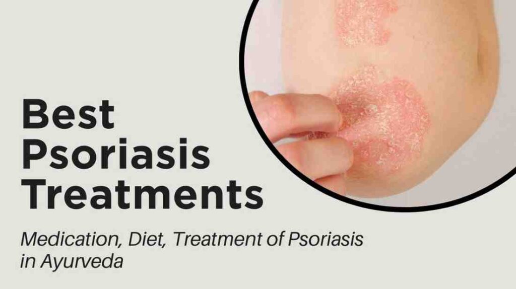 best psoriasis treatments