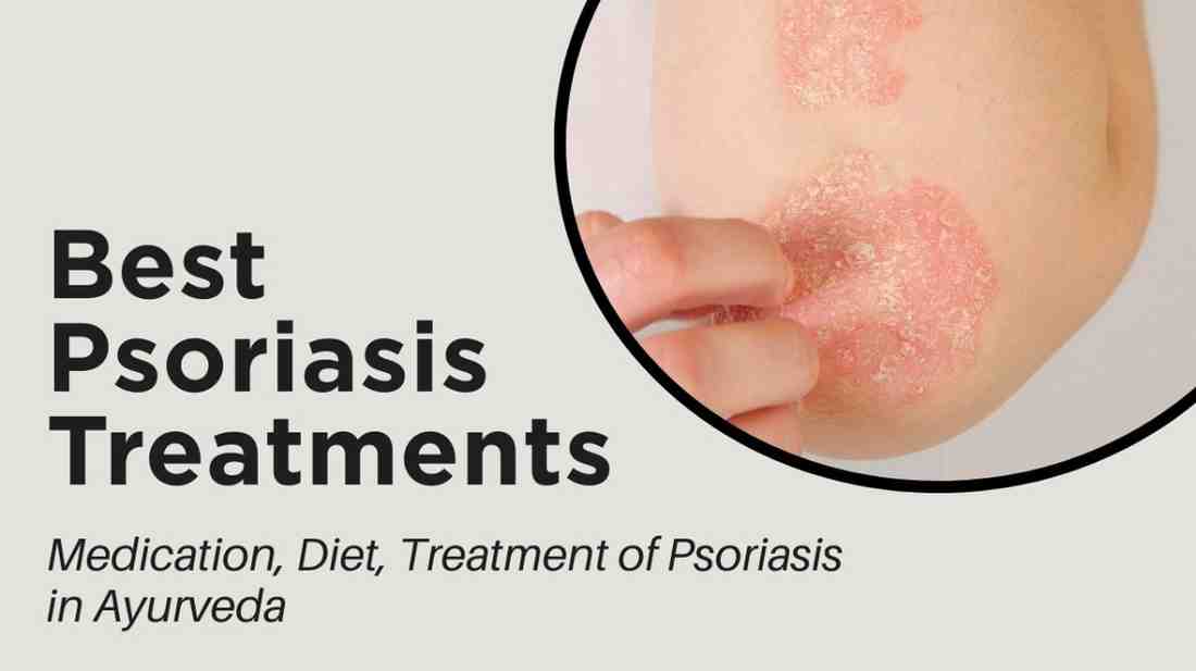 Psoriasis Treatments - Scalp Psoriasis Treatment, Medication, Diet