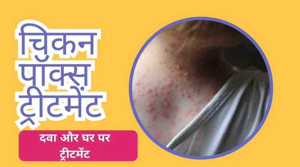 chicken pox treatment in hindi