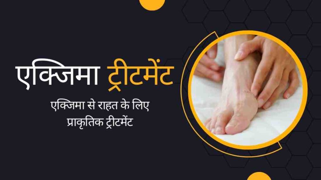 eczema treatment in hindi