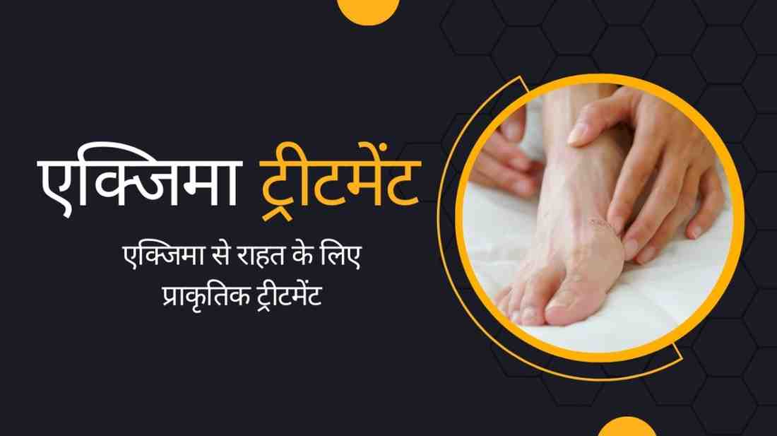 eczema treatment in hindi