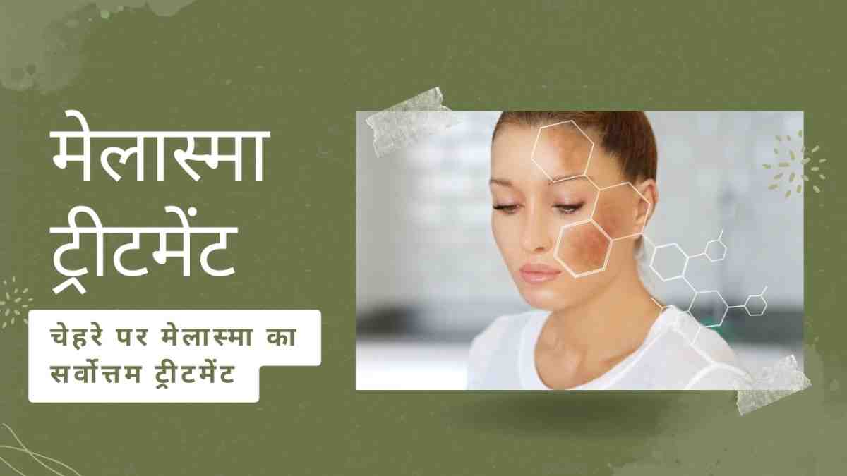 मेलास्मा ट्रीटमेंट: चेहरे पर मेलास्मा का सर्वोत्तम ट्रीटमेंट, Melasma Treatment in Hindi