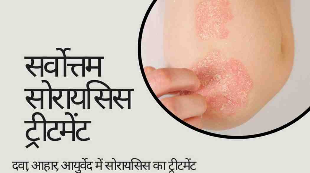 सर्वोत्तम सोरायसिस ट्रीटमेंट – दवा, आहार, आयुर्वेद में सोरायसिस का ट्रीटमेंट, Psoriasis Treatment in Hindi
