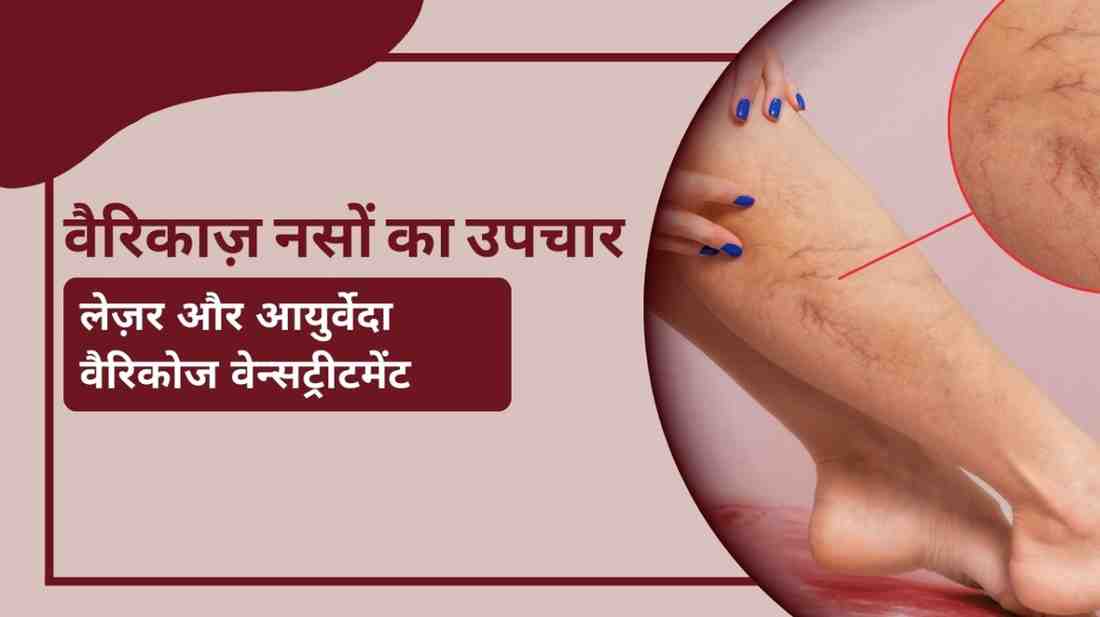 वैरिकाज़ नसों का उपचार – लेज़र और आयुर्वेदा वैरिकोज वेन्सट्रीटमेंट, Varicose Veins Treatment in Hindi