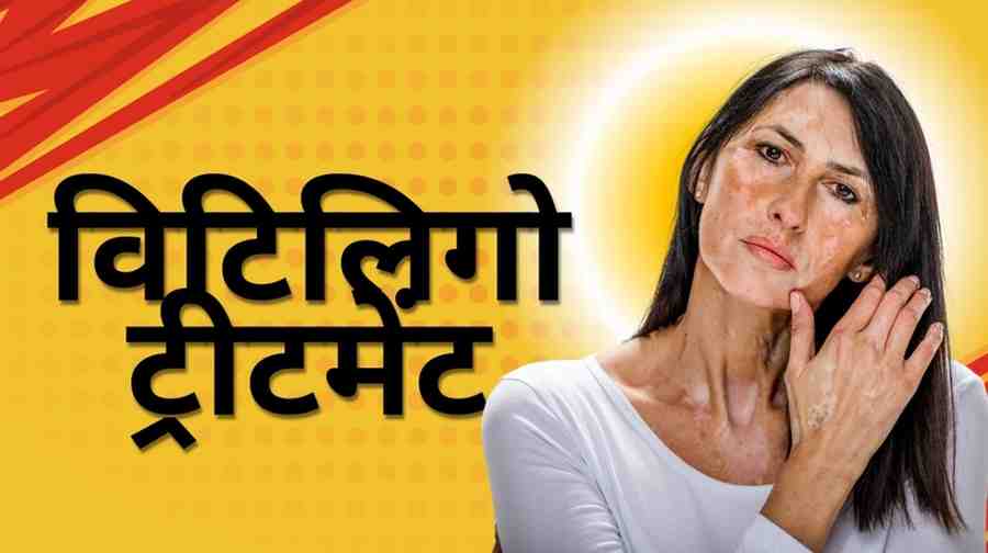 vitiligo treatment in hindi