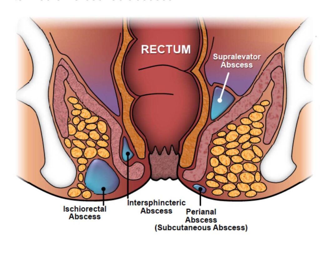 Fistula Treatment in Hindi