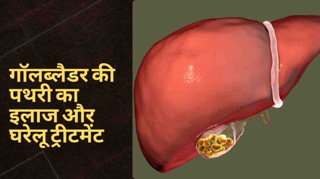 gallbladder stones treatment in hindi