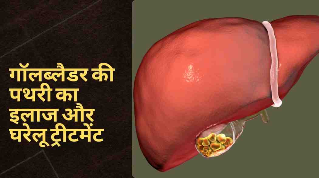 gallbladder stones treatment in hindi