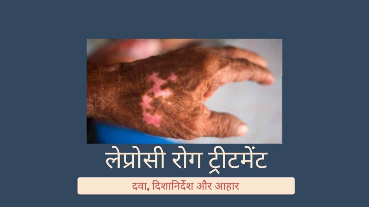लेप्रोसी रोग ट्रीटमेंट: दवा, दिशानिर्देश और आहार, Leprosy Treatment in Hindi