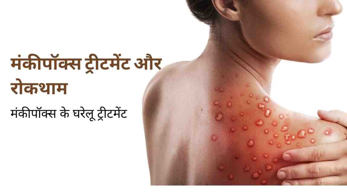 मंकीपॉक्स ट्रीटमेंट और रोकथाम: मंकीपॉक्स के घरेलू ट्रीटमेंट, Monkeypox Treatment in Hindi