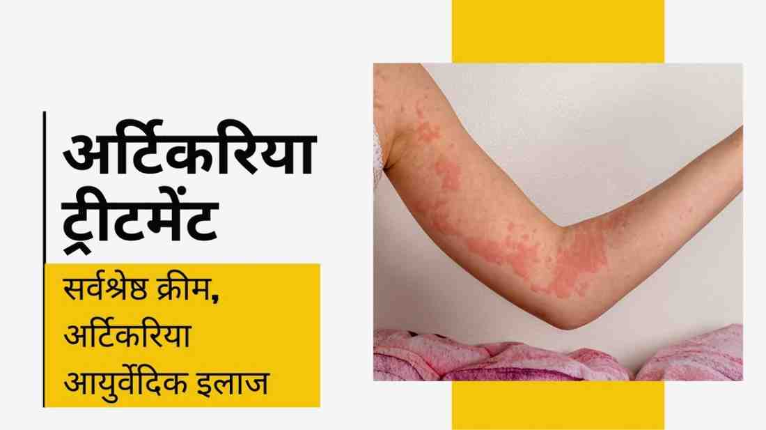 अर्टिकरिया ट्रीटमेंट: सर्वश्रेष्ठ क्रीम, अर्टिकरिया आयुर्वेदिक इलाज, Urticaria Treatment in Hindi