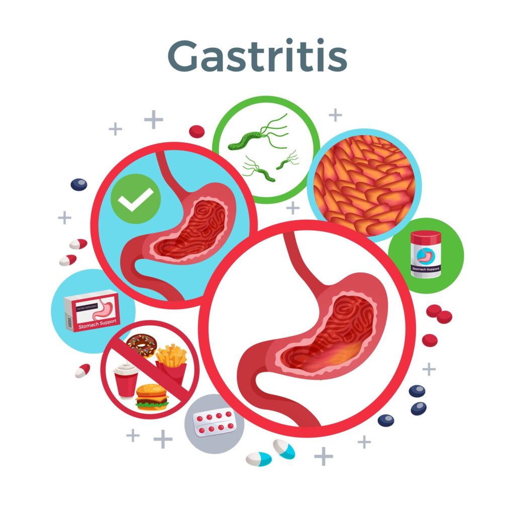 Gastritis Treatment