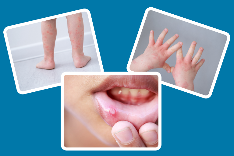 Hand Foot and Mouth Disease Treatment