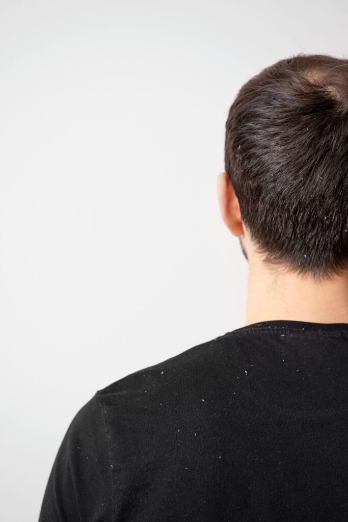 How to get Rid of Dandruff