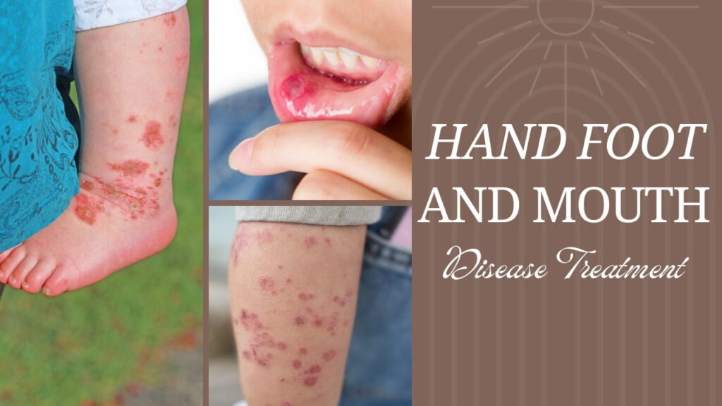 hand, foot & mouth disease treatment