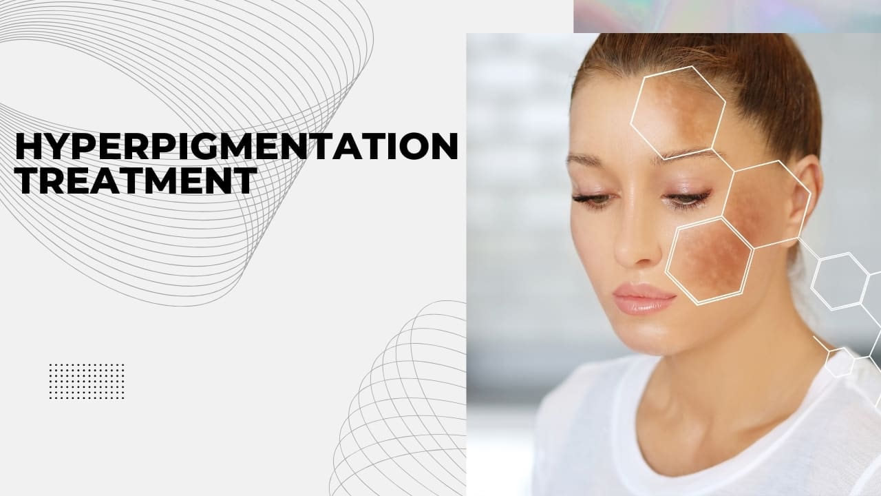 Hyperpigmentation Treatment - Best Treatment for Hyperpigmentation