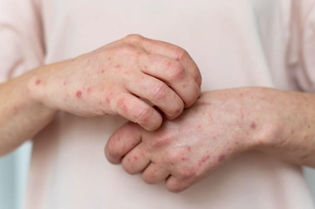 Common Skin Infections