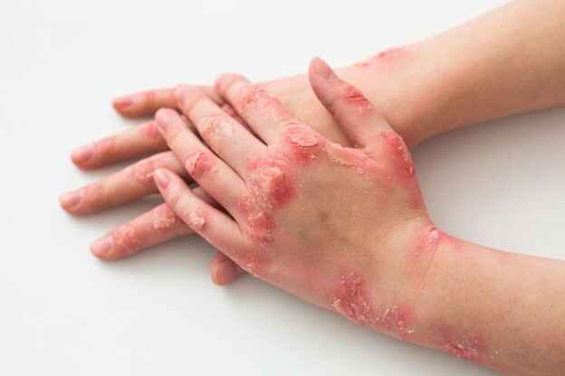 photos of bacterial skin infections