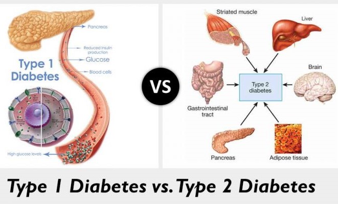 difference between type 1 and 2 diabetes (2)