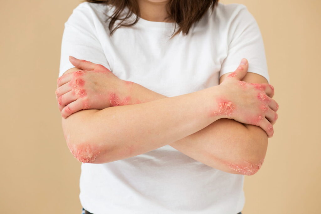 bacterial skin infection