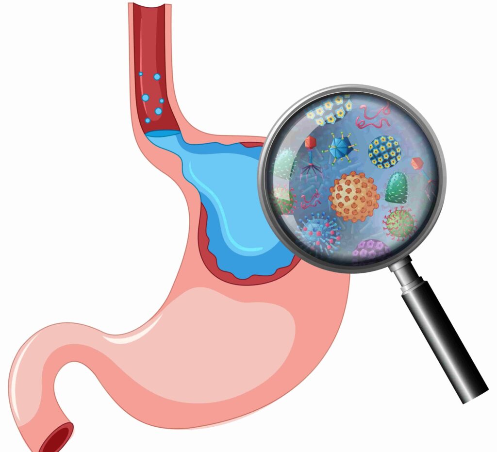 bacterial infection in stomach