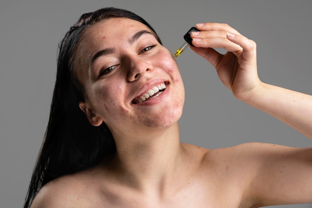 vitamin c serum for acne prone skin