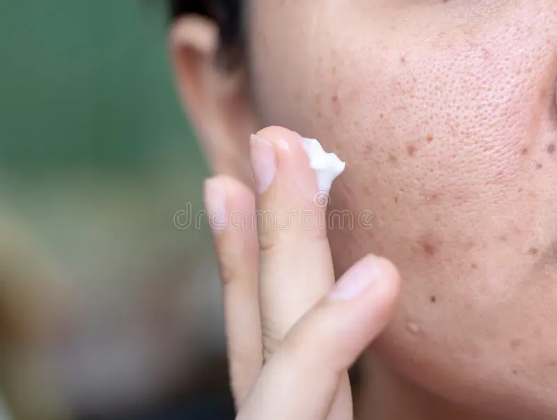 Mederma Cream